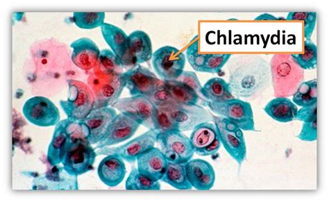 Chlamydia Trachomatis Scheda Batteriologica Ed Approfondimenti