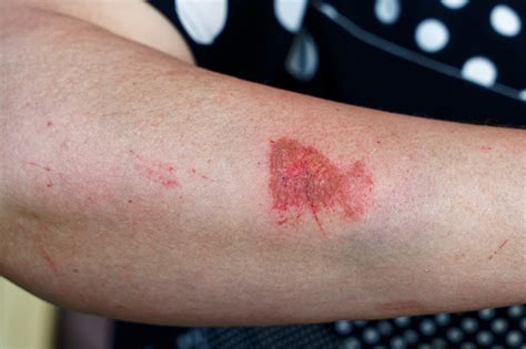 Scratched Skin On Arm Stock Photo Download Image Now Istock