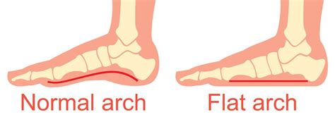 Flat Footed Problems Faced By People With Fallen Arches Premier