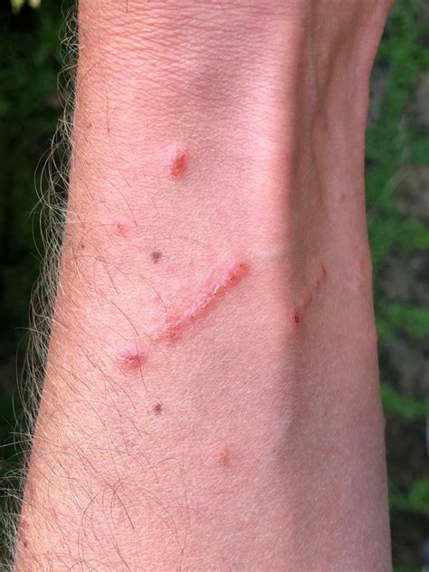 Poison Ivy Rash On Arm
