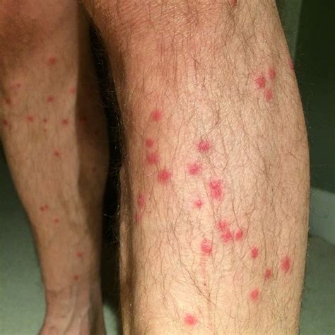 Commonly known as 'sand flies', biting midges are small flies renowned for their nuisance biting associated with habitats such as coastal lagoons, estuaries, mangrove swamps and tidal flats. Midge bites — how to recognise midges, treat bites and ...