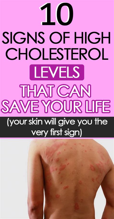 10 Symptoms Of High Cholesterol That You Shouldnt Ignore Hello Healthy
