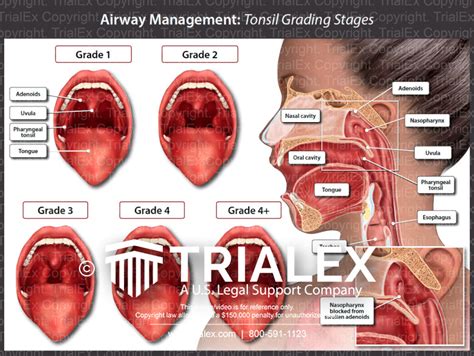 Airway Management Tonsil Grading Stages Trialexhibits Inc