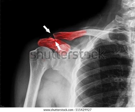 X Ray Collarbone Stock Photo 115429927 Shutterstock