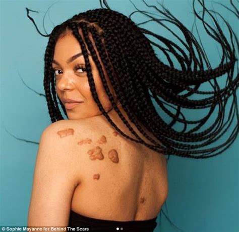 Woman Proudly Shows Off Her Keloid Scars In Viral Photos Big World Tale