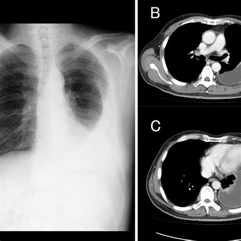 Figure1chest Radiography A And Computed Tomography Of The Chest B