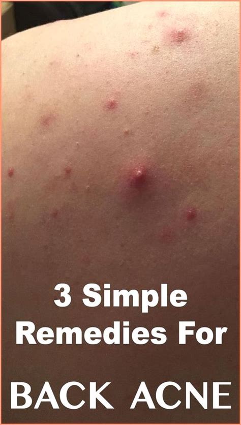 3 Best Remedies For Back Acne Back Acne Remedies Acne Body Acne