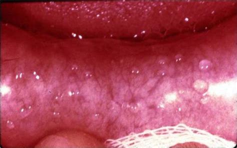 Cancerous bumps on the roof of your mouth can be treated with chemotherapy or radiation therapy. Blog Archives