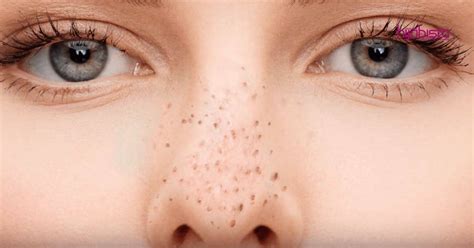 Antaranya, telur putih, mask, nose strip (apa kebenda tah ejaannya). Hilangkan Whitehead & Blackhead Tanpa Pergi Spa, Hasilnya ...