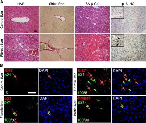 Senescence Of Activated Stellate Cells Limits Liver Fibrosis Cell