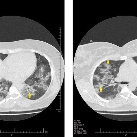 Axial Non Contrast Hrct Scan Of Chest Shows Bilateral Diffuse Mixed