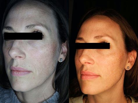 Dermal Fillers Before And After Photos Palm Clinic