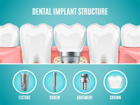 Dental Implants With Cbct Technology Joplin Dental Care