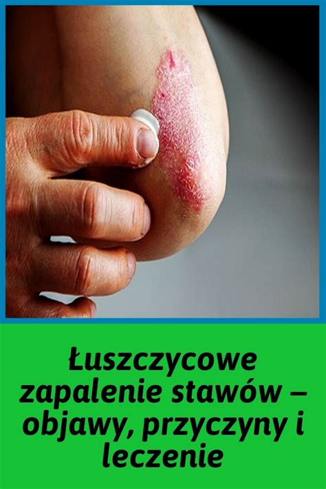 Łuszczycowe Zapalenie Stawów Objawy Przyczyny I Leczenie