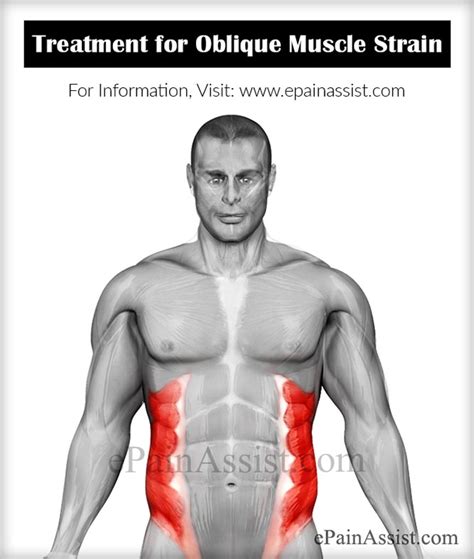 Oblique Muscle Straincausessymptomstreatmentrecovery