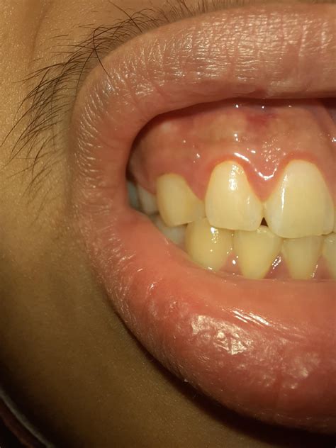 Painless Yellow Bumps On The Upper Gum Line Rdentalhygiene