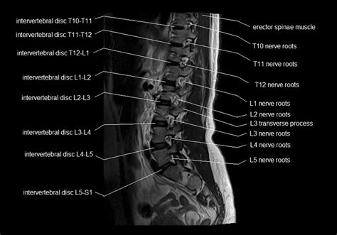 Mri Spine Anatomy Free Mri Lumbar Spine Sagittal Cross Sectional Hot