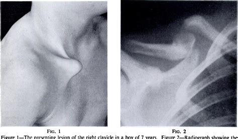 Figure 1 From Congenital Pseudarthrosis Of The Clavicle Semantic Scholar