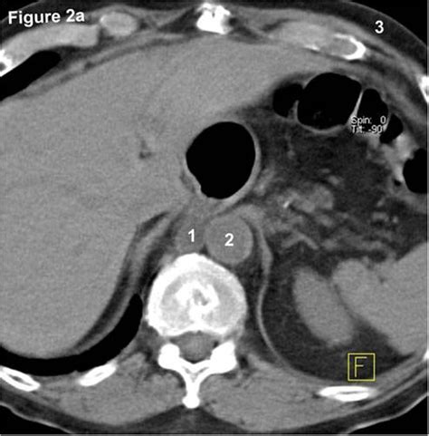 Patient With A History Of Esophageal Carcinoma Anon Enhanced Ct Of