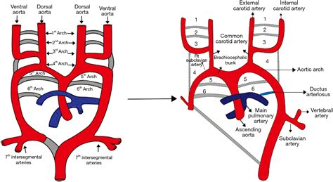 Aortic Arch Lulijs