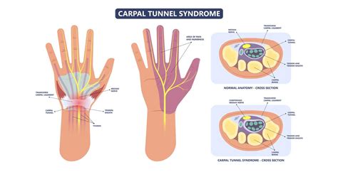 Pemf Therapy For Carpal Tunnel Syndrome Sentient Element