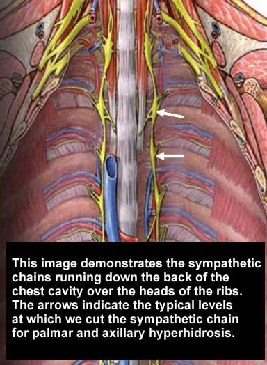 thoracoscopic vats sympathectomy stanford health care