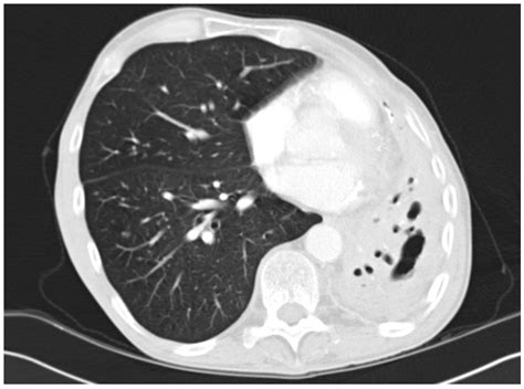 Jof Free Full Text Chronic Pulmonary Aspergillosis—where Are We