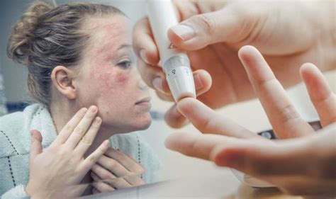 Type 2 Diabetes Xerosis Refers To Skin Feeling Dry And Is A Warning Of