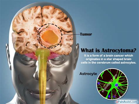 A brain tumor describes a cancerous mass within the cavity of the skull associated with the brain. Astrocytoma|Causes|Symptoms|Treatment|Prognosis|Life ...