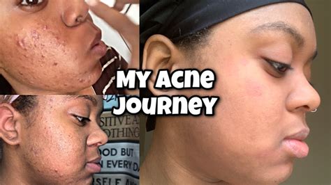 How I Cleared My Acne My Clear Skincare Journey Months On Accutane Update Side Effects