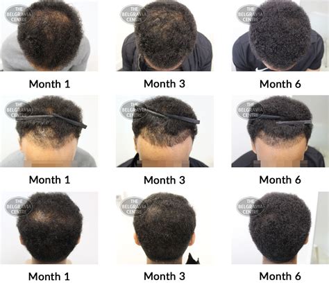 Top 120 2 Months Hair Growth Male Polarrunningexpeditions