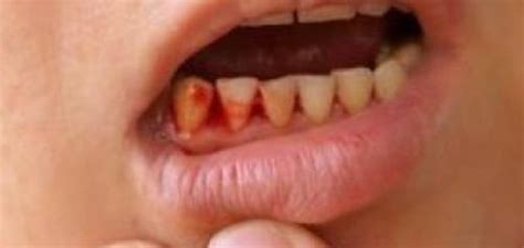 Check spelling or type a new query. تفسير حلم خروج دم من الفم للعزباء والمتزوجة والحامل ...