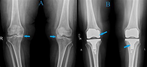 Cureus Stress Fracture Of The Femoral Neck Following Total Knee