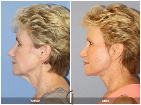 Neck Lift Before And After Photos Patient 15 Dr Kevin Sadati