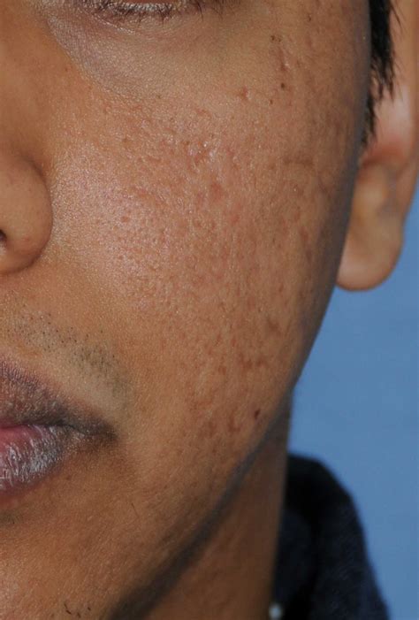 Black People Acne Scars Before And After