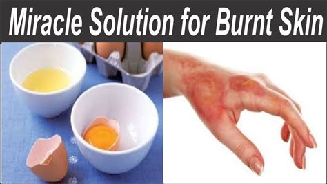 How To Treat A Burn Burn Hand Solution At Home Burn Skin Remedy