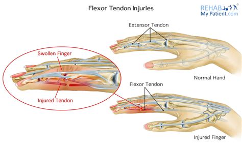Hand Tendon Anatomy Anatomical Charts And Posters