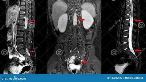 White Spots On Mri Lumbar Spine