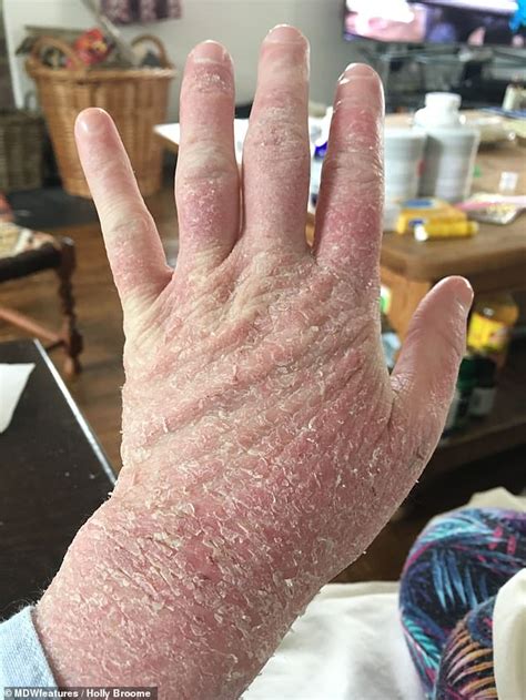 Eczema Stricken Woman Makes Recovery By Ditching Steroid Creams And
