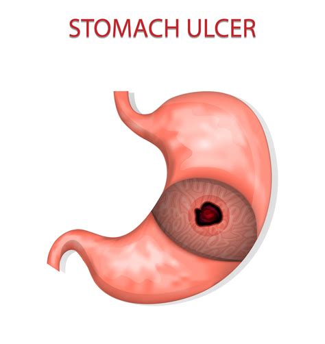 What Causes Stomach Ulcers Gut Authority