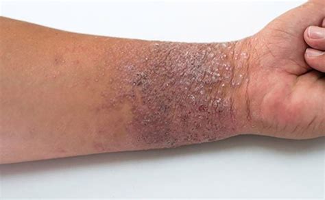 Dermatitis Atópica Qué Es Causas Síntomas Y Tratamiento 2023