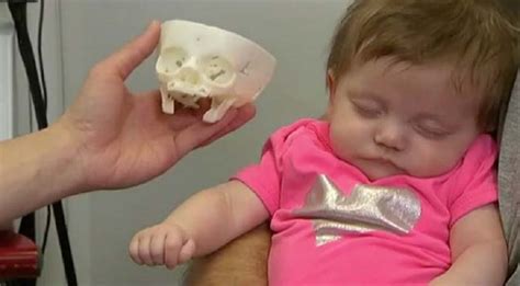 3d Printed Skull Saves The Newborn