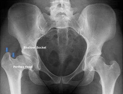 Perthes Disease St Louis Mo Less Invasive Hip Replacement