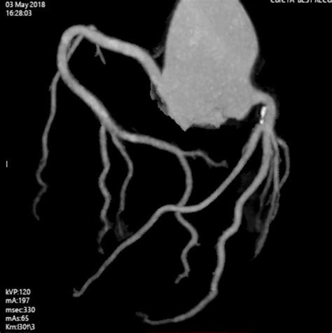 Ct Coronary Angiography Faqs Western Radiology Perth