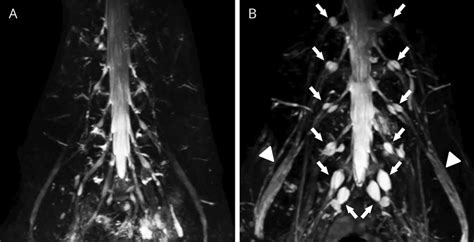 D Magnetic Resonance Neurography 3d Mrn Study Of Lumbosacral Nerves