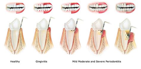 Periodontics Vincentia Dental Care Vincentia Nsw