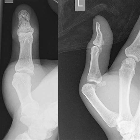 Volar Dislocation Of The Left Thumb Metacarpophalangeal Joint With The