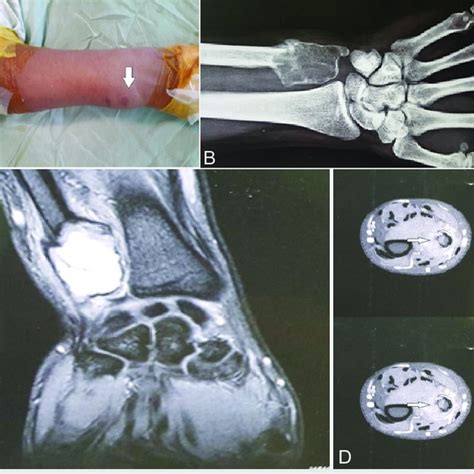 A Clinical Pic Showing Giant Cell Tumor Distal Ulna B X Ray