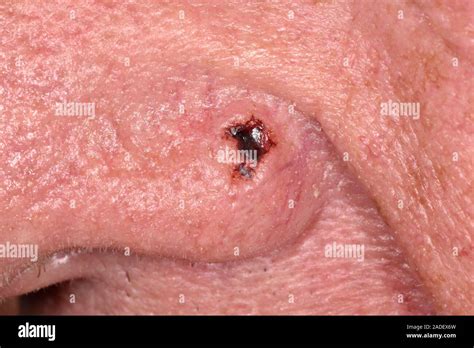 Model Released Basal Cell Carcinoma On The Nose Of A 78 Year Old Man