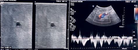 Doppler Venoso Dos Membros Inferiores Fluxo Cirurgia Vascular My Xxx